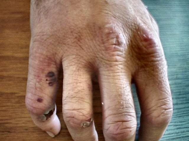 Broken fingers in hand